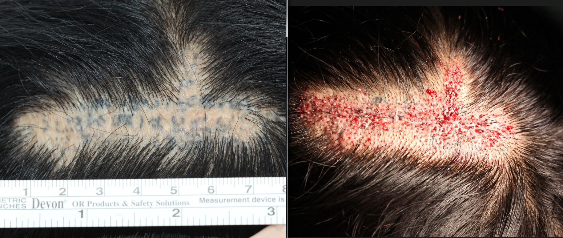 FUE hair transplant in scar 